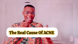 The Hidden Trigger Behind Your Acne Breakouts