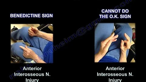 Anterior Interosseous nerve,  O K  Sign - Everything You Need To Know - Dr. Nabil Ebraheim - DayDayNews