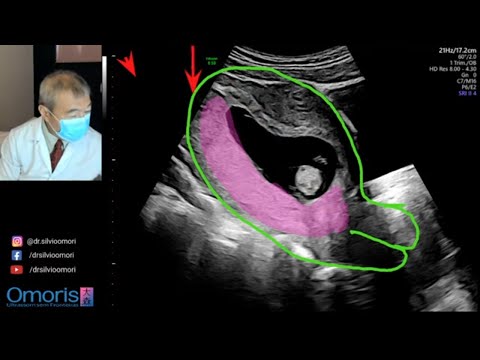 Video: V ktorom týždni sa tvorí placenta?
