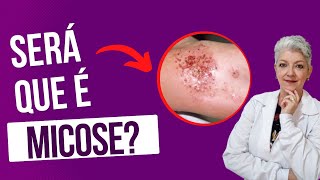 MICOSE ou DISIDROSE Saiba a diferença
