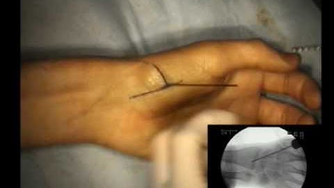 Percutaneous Transtrapezial Scaphoid Fixation
