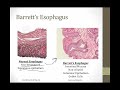 Esophageal Disorders || Boards and Beyond || Gastroenterology