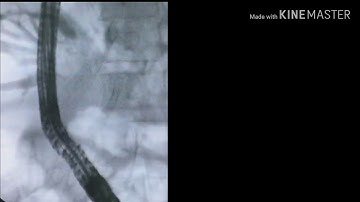 ERCP : Technique for Stone Extraction by Basket