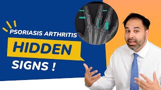psoriasis arthritis radiology as you never seen before | Dr Omer Awan