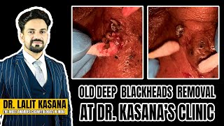 OLD DEEP BLACKHEADS REMOVAL AT DR.KASANA&#39;S CLINIC