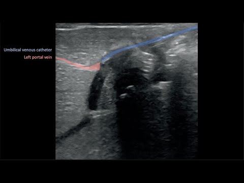 Ultrasound-guided UVC 2_Umbilical Venous Catheter Malposition (Kozyak et al)