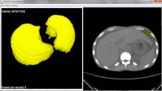 Graph-cut volume segmentation - Lungs