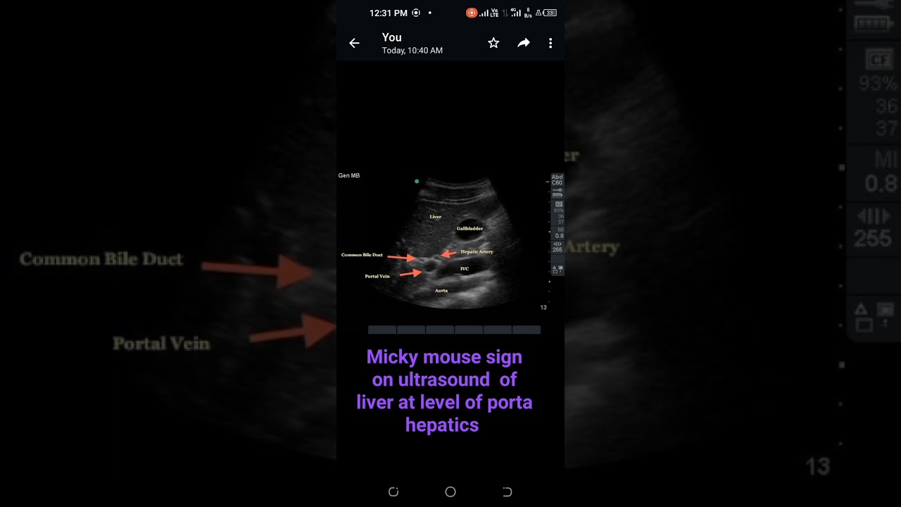 Mick mouse sign on ultrasound of liver at level of porta hepatics