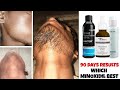 Best minoxidil for beard growth 2026 | 90 days beard growth results minoxidil | minoxidil beard |