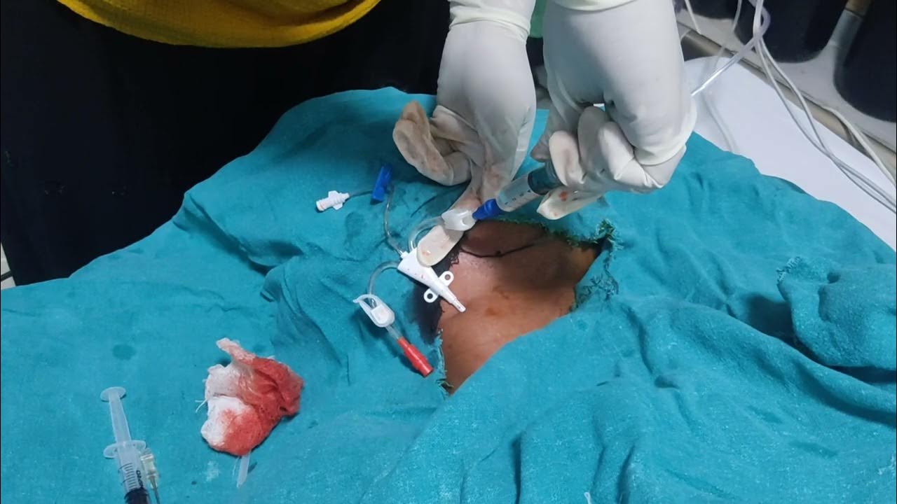 HEMODIALYSIS CATHETER INSERTION TECHNIQUE YouTube