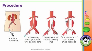HCGTV: Webinar - Meet the new EVAR Codes
