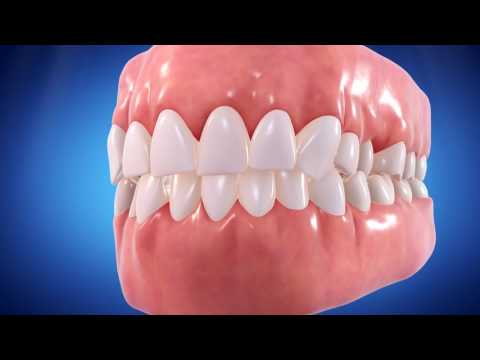 Passes Dental | Invisalign® Teeth Straightening | (516) 858-5921