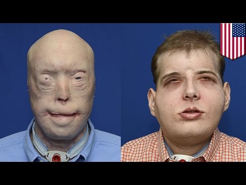 Video: Pemindahan Wajah: Seorang Penduduk Perancis Menjalani Dua Operasi Unik - Pandangan Alternatif