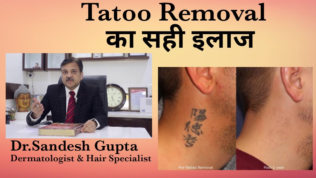 Tattoo Removal with expert dermatologist in delhi
