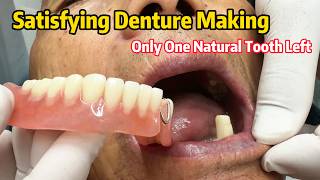 Single Abutment Denture Reinforced with Metal Mesh | Impression to Final Delivery#RemovableDenture