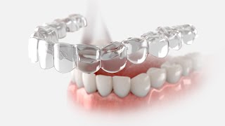 How Can a Custom Mouthguard Keep Your Smile Protected?