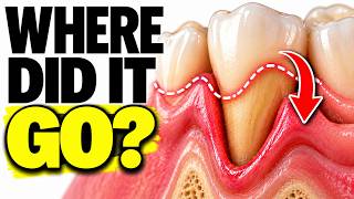 Information Your Gums Are Shrinking—Here's Why (And How to Stop It) Update