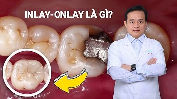 Tại sao trám răng sâu bằng inlay-onlay?