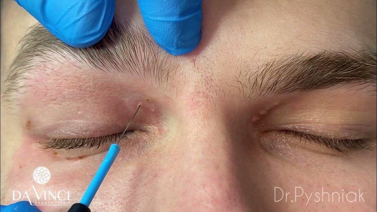 Xanthelasma. Removal of xanthelasma / Ксантелазми. Видалення ксантелазм