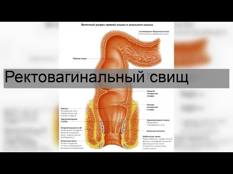 Ректовагинальный свищ