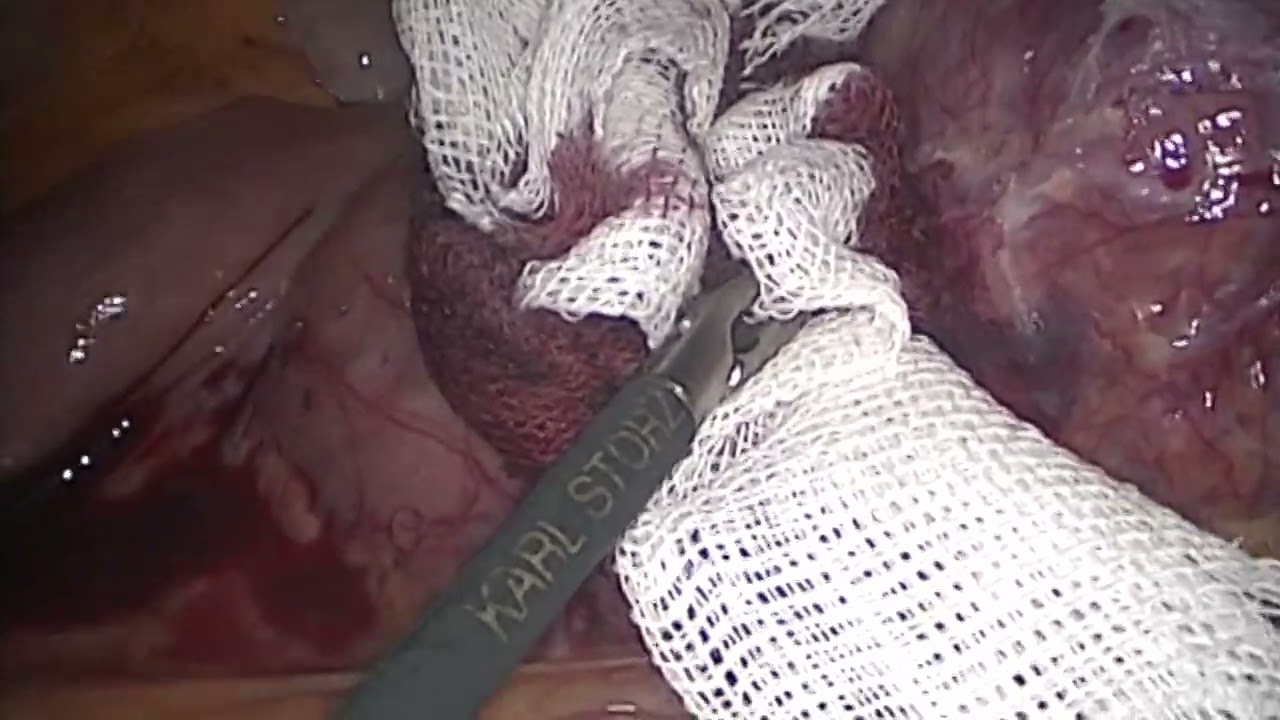 Параганглиома