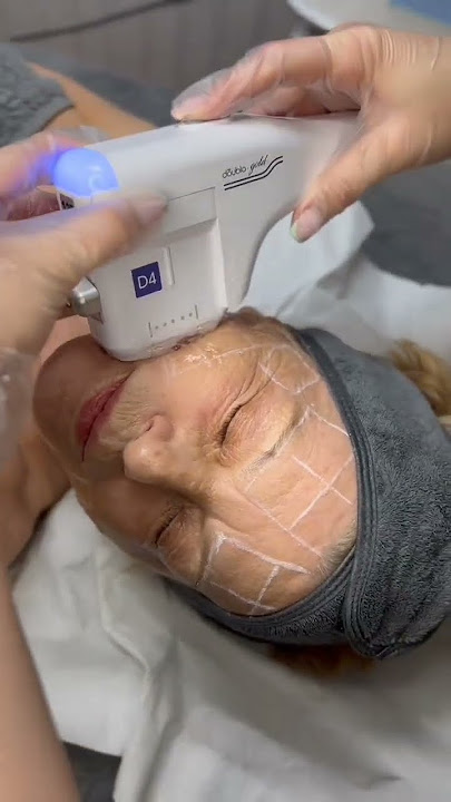 Radio Frequency and HiFu combination Treatment - Clinicbe #rf #hifu #clinicbe #skin  #antiaging