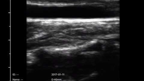 128 Elements 7 5 10mhz Linear Probe Video
