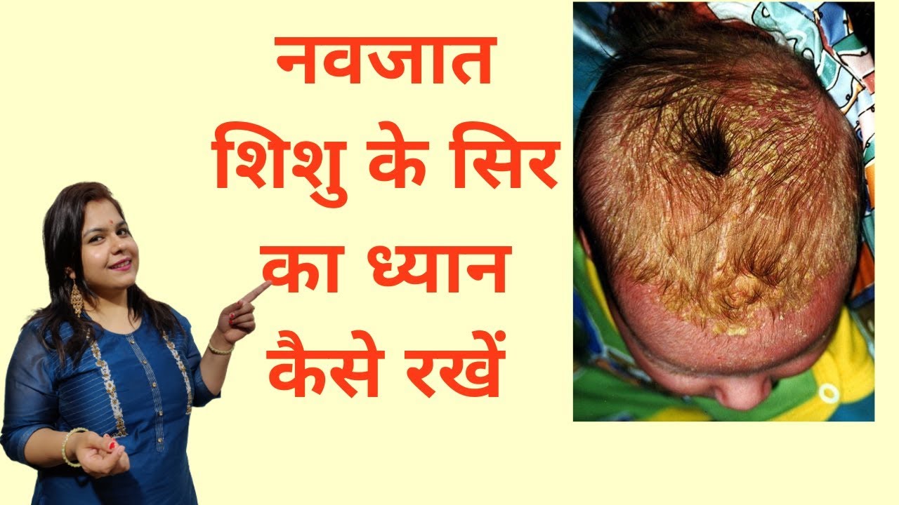 Cradle cap, hair loss, hair dandruff in babies नवजात शिशु के सिर का