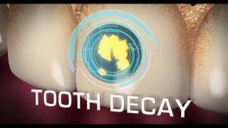 [ORAL-B] THE TRUTH IN TOOTH DECAY