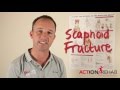 Scaphoid Fracture Treatment
