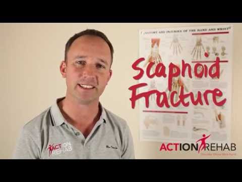 Video: Kdy zlomenina scaphoidea přestane bolet?