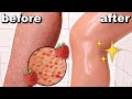HOW TO GET RID OF STRAWBERRY LEGS IN ONE DAY! Get Rid Of Keratosis Pilaris And Dark Spots On Legs