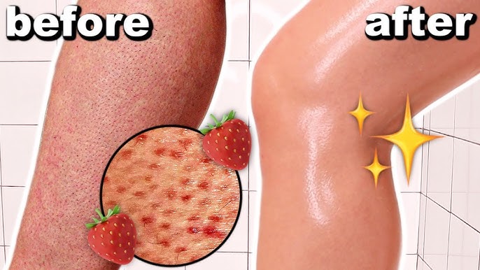 HOW TO GET RID OF STRAWBERRY LEGS IN ONE DAY! Get Rid Of Keratosis Pilaris  And Dark Spots On Legs - YouTube