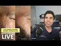 Dr. Qazi Discussing Acne Scars, TCA Cross, Fillers, Lasers | Unsponsored LIVE | 3.11.2026