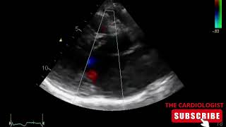 Hypertrophic Cardiomyopathy | SAM | MR
