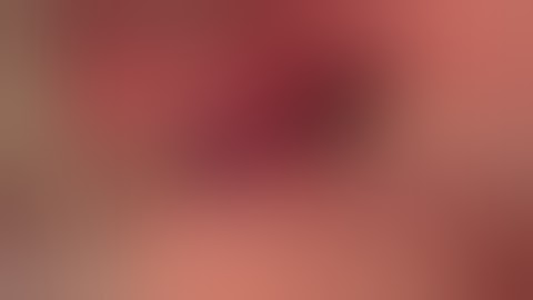 Sinus augmentation using HPISE and Ridge Augmentation using Sticky Decalcified Autologous Tooth Bone