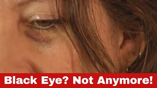 Download Lagu How to Get Rid of a Black Eye - Proven Tips You'll Wish You Knew Sooner! MP3 Download Lagu How to Get Rid of a Black Eye - Proven Tips You'll Wish You Knew Sooner! MP3