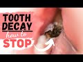 Tooth Decay (Treatment for a Tooth Cavity)