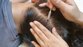 Most Tingly Scalp Check ASMR 😴 Instant Sleep in Minutes