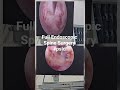 Full Endoscopic Spine Surgery #endoscopicspinesurgery #psld