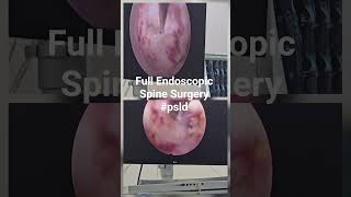 Full Endoscopic Spine Surgery #endoscopicspinesurgery #psld