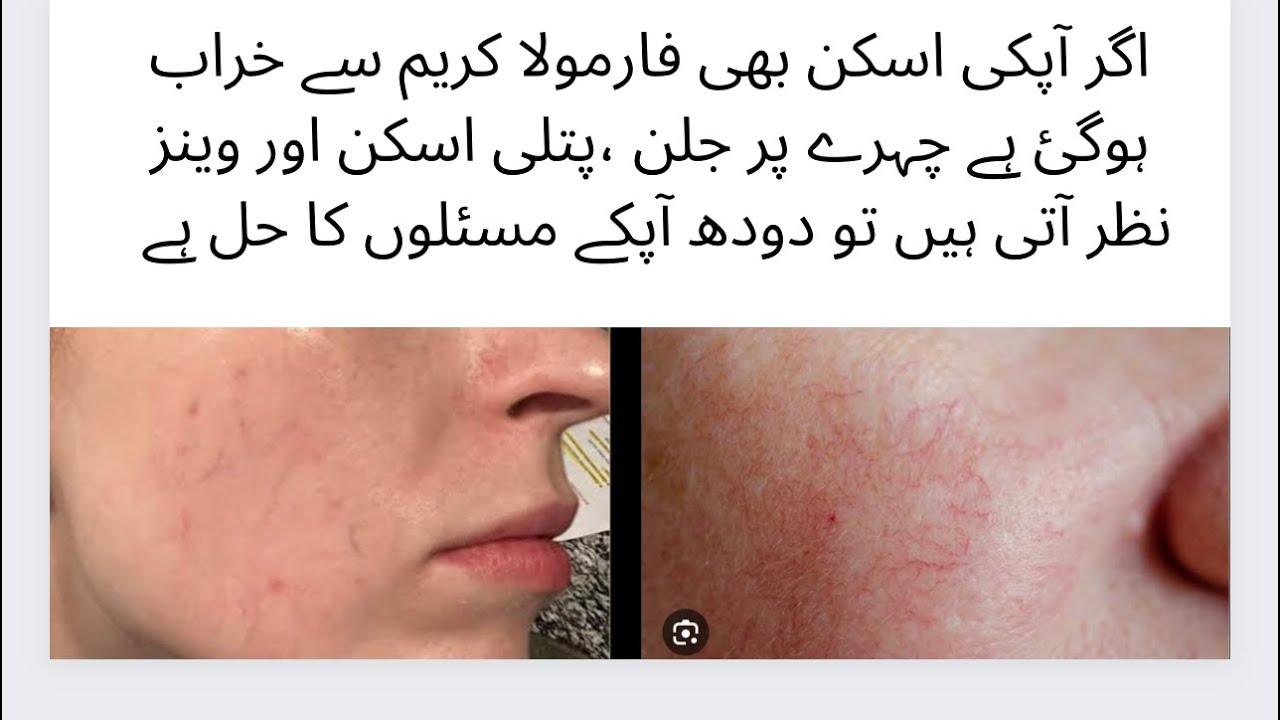 Formula Cream Side Effects solution Treatment Home Remedy How