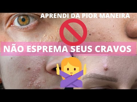 Vídeo: Os comedões fechados podem inflamar?