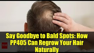 Say Goodbye to Bald Spots: How PP405 Can Regrow Your Hair Naturally
