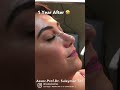 Rhinoplasty Before 1 Year After TAŞ Nose Crown