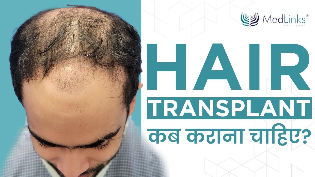 Hair Transplant कब कराना चाहिए? Best Season/Time for Hair Transplant in Hindi Medlinks YouTube