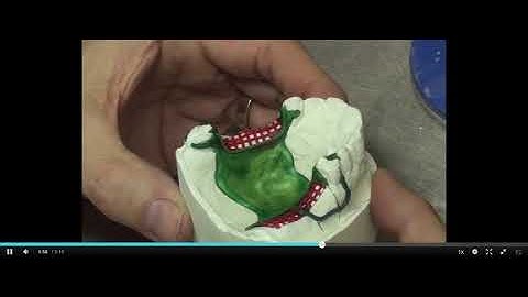 Kennedy Class II Mod 1  Wax patterning   Finishing beading   mmutube