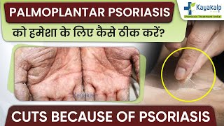 Palmoplantar psoriasis Cure/Treatment In India | Palmoplantar psoriasis का उपचार कैसे करें?