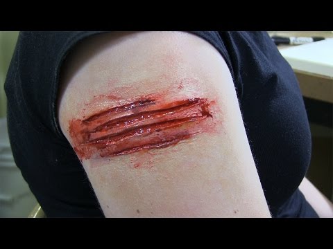 Low Cost Prosthetic Transfers Part 1
