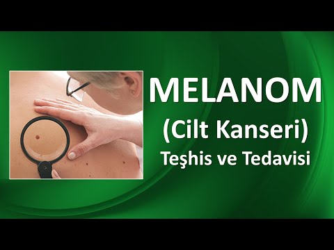 Video: Oral Melanom Tedavisi – Ağız Kanserli Köpekler İçin Tedavi Seçenekleri